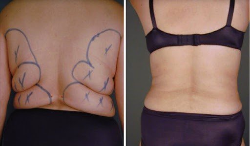 back fat removal
