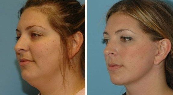 facial fat removal