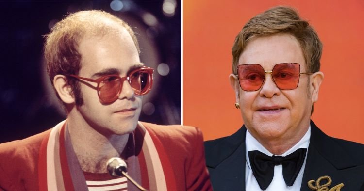 8 Celebrities Who Had A Hair Transplant | Newlyme