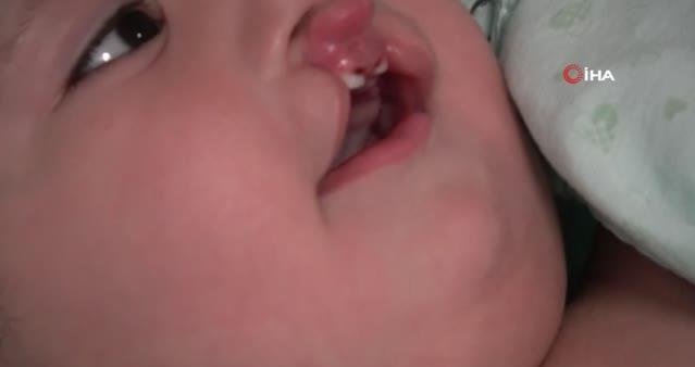 bebeklerde dudak damak yarığı