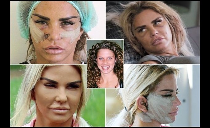 katie price before after