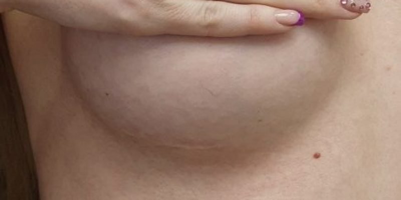 breast augmentation scar