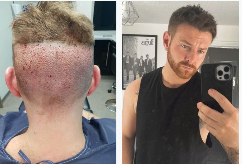 Spent PS5,000 on Hair Transplant to Transform into Beckham | Newlyme