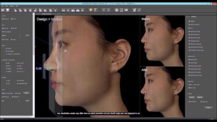 3d image programs for rhinoplasty