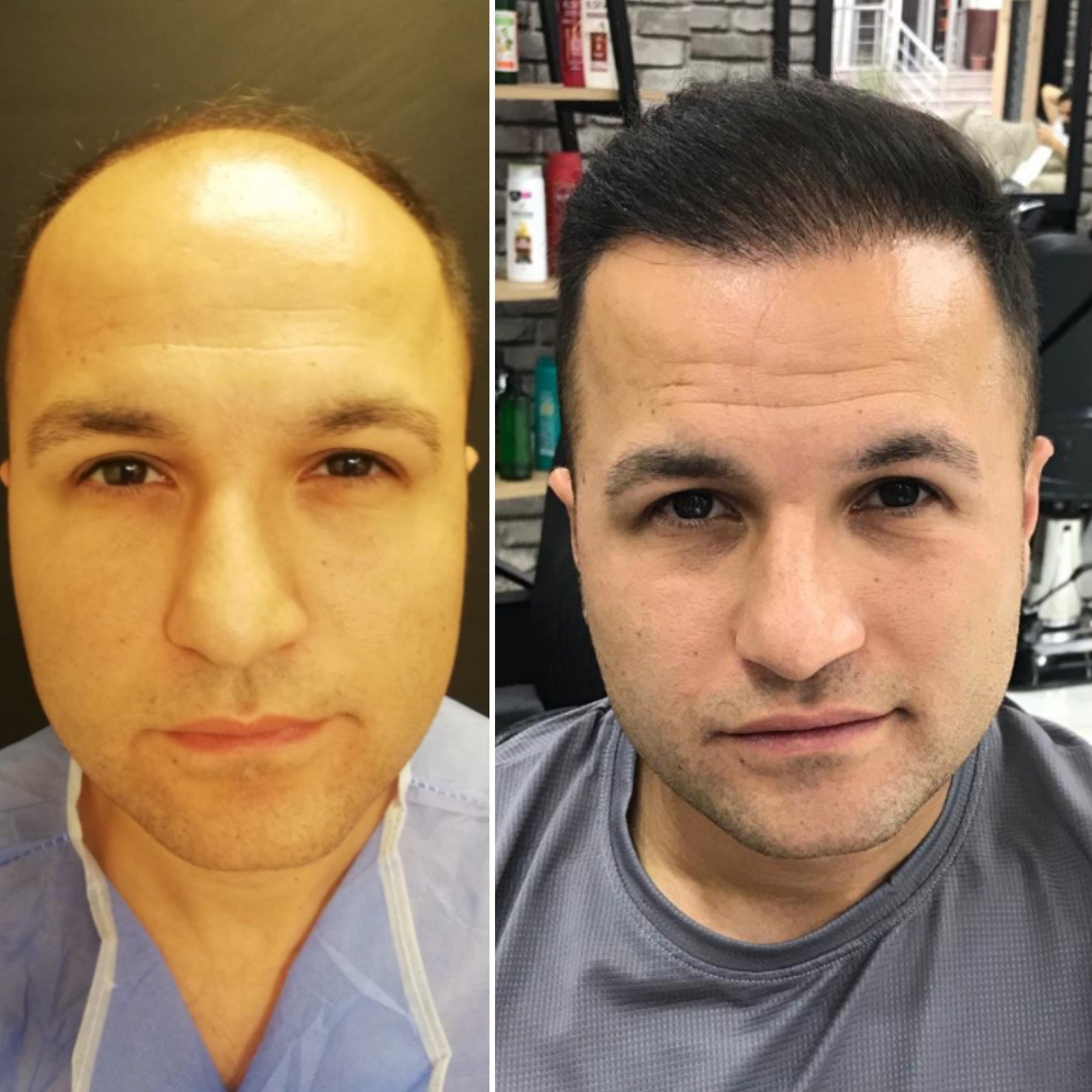 Emphair hair transplant before after