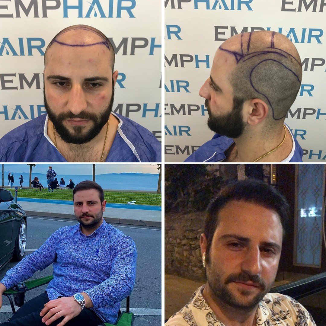 Emphair hair transplant before and after