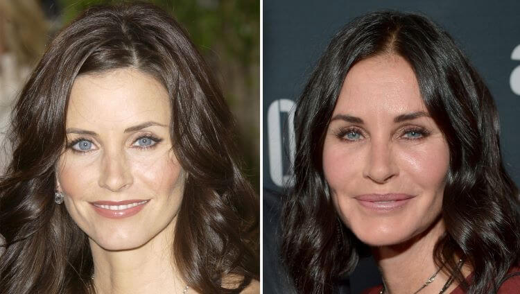 courtney cox cosmetic injections