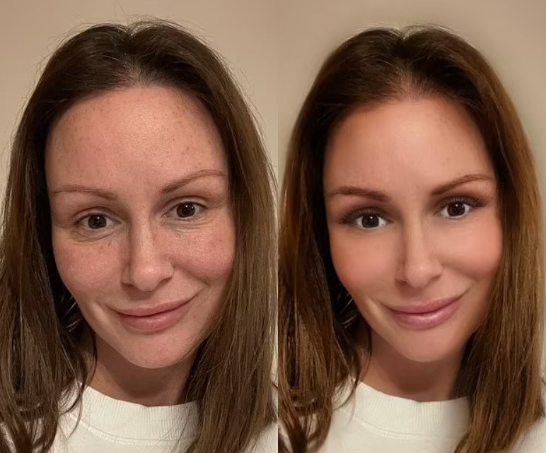 Chanelle Hayes's hair transplant before and after