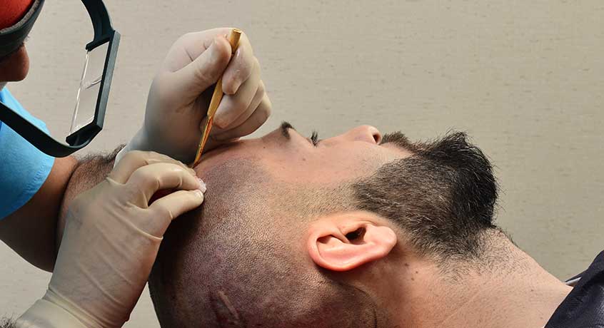 placement of hair grafts