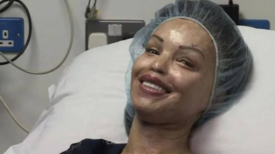 Katie Piper's surgery
