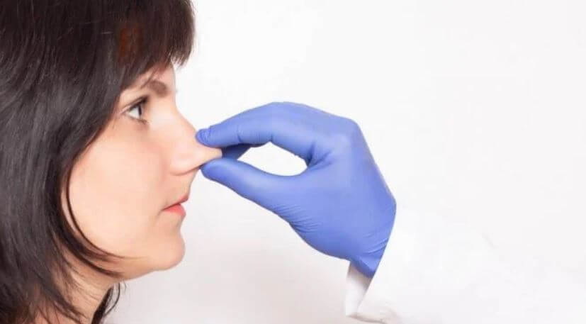 meshfill for non surgical rhinoplasty