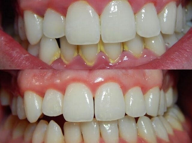 Diş Taşı Temizliği