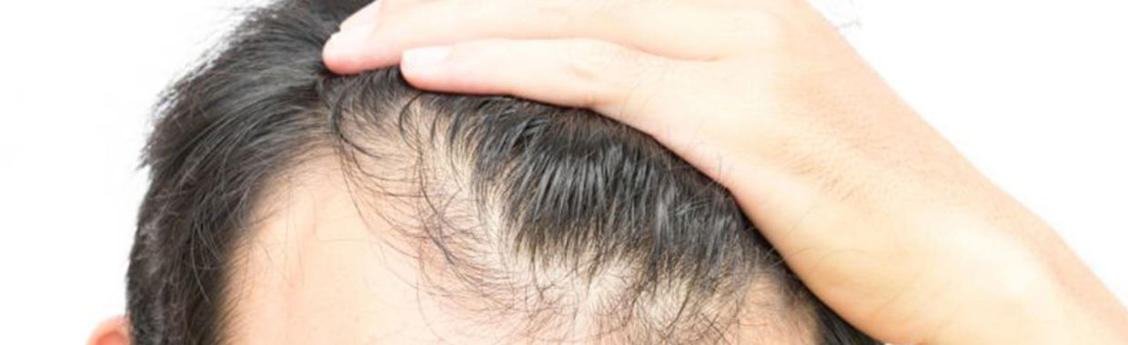 3 Hair Loss Treatments That Work | Newlyme